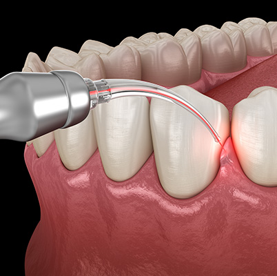 Darryl Lieberman, DDS   Associates | Crowns  amp  Caps, Cosmetic Dentistry and Teeth Whitening