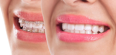 Darryl Lieberman, DDS   Associates | Invisalign reg , Dentures and Implant Restorations